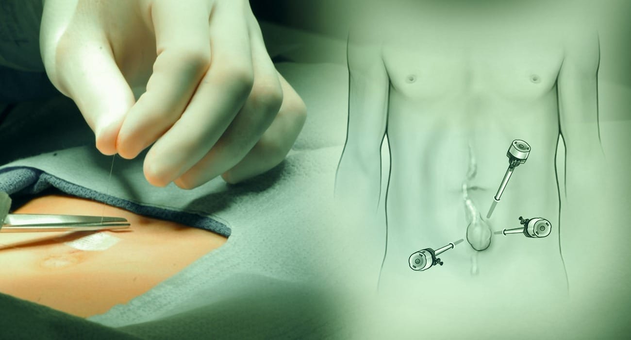 Understanding Hernia Surgery – Symptoms, Procedure, and Aftercare